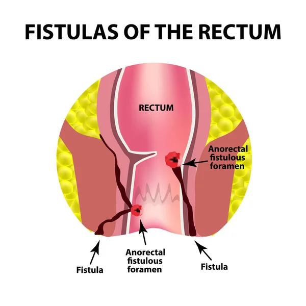 Tipos de fístulas del recto. Paraproctitis. Ano. Absceso del recto. Infografías. Ilustración vectorial sobre fondo aislado — Vector de stock