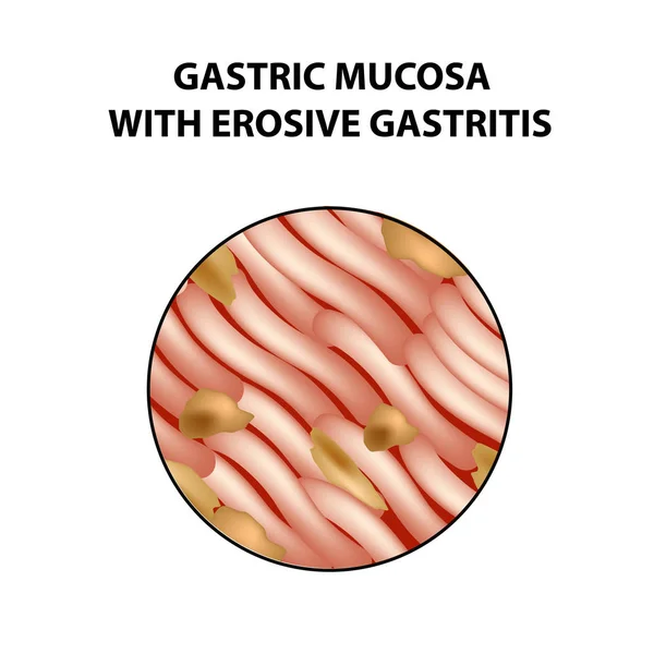 Estómago mucoso con gastritis erosiva. Infografías. Ilustración vectorial sobre fondo aislado — Vector de stock