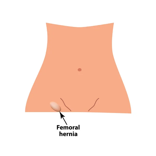 Hernia femoral. hernia intestinal. Infografías. Ilustración vectorial sobre fondo aislado . — Vector de stock