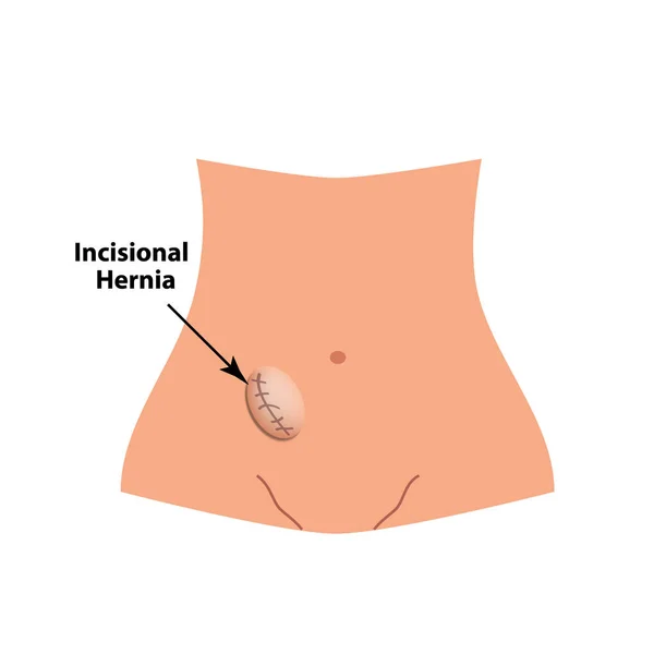 Ernia incisionale. ernia intestinale. Infografica. Illustrazione vettoriale su sfondo isolato . — Vettoriale Stock