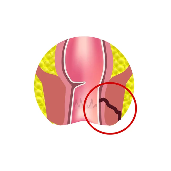 Types de fistules du rectum. Paraproctite. Anus. Abcès du rectum. Infographie. Illustration vectorielle sur fond isolé — Image vectorielle