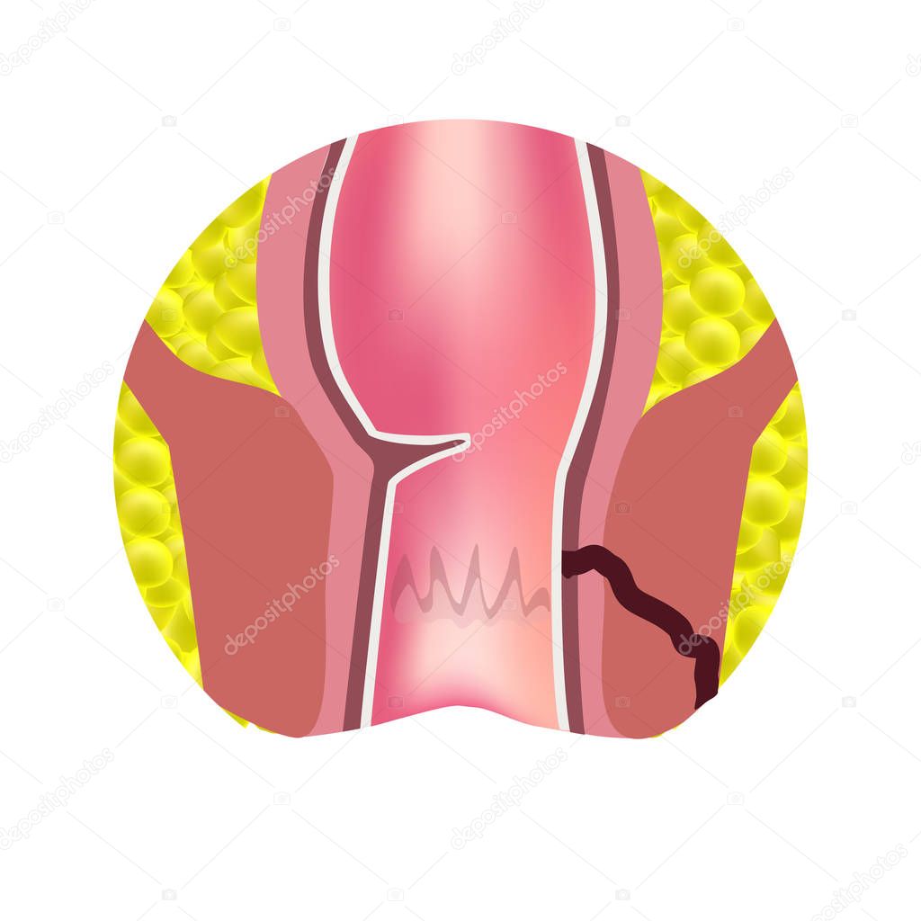 Types of fistulas of the rectum. Paraproctitis. Anus. Abscess of the rectum. Infographics. Vector illustration on isolated background