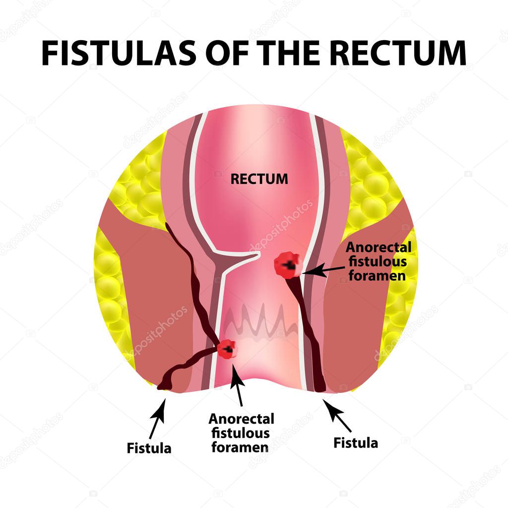 Types of fistulas of the rectum. Paraproctitis. Anus. Abscess of the rectum. Infographics. Vector illustration on isolated background
