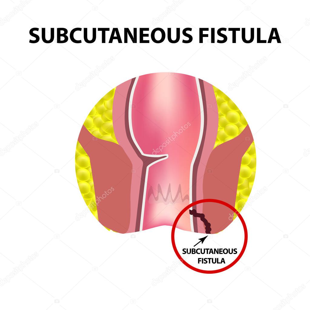 Types of fistulas of the rectum. Paraproctitis. Anus. Abscess of the rectum. Infographics. Vector illustration on isolated background