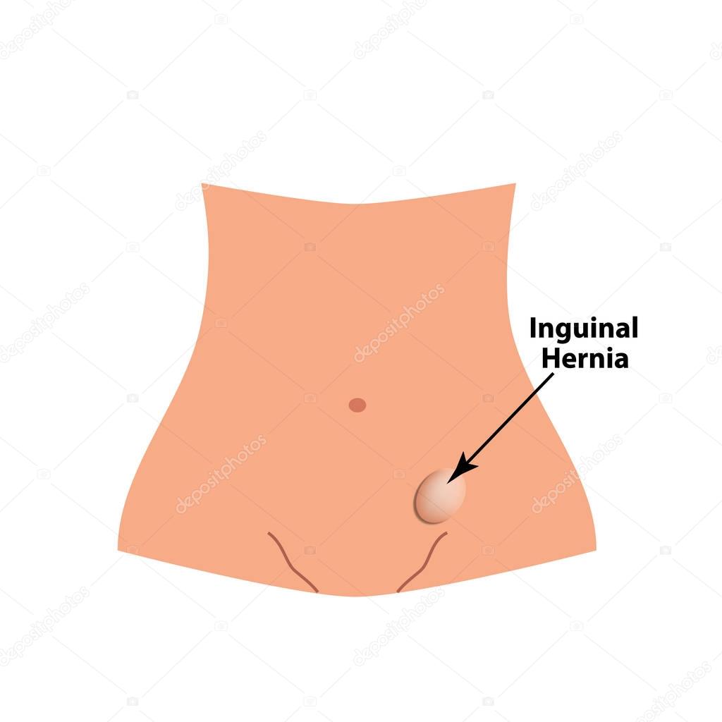 Inguinal hernia. intestinal hernia. Infographics. Vector illustration on isolated background.