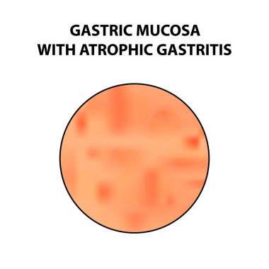 Mukus mide atrofik gastrit ile. Infographics. Vektör illüstrasyon izole arka plan üzerinde