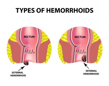 Dış ve iç hemoroid iki türü vardır. Rektum yapısı. Bağırsak. iki nokta üst üste. İç ve dış hemoroidal düğüm. Infographics. Vektör illüstrasyon izole arka plan üzerinde