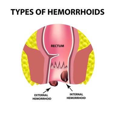 Dış ve iç hemoroid iki türü vardır. Rektum yapısı. Bağırsak. iki nokta üst üste. İç ve dış hemoroidal düğüm. Infographics. Vektör illüstrasyon izole arka plan üzerinde