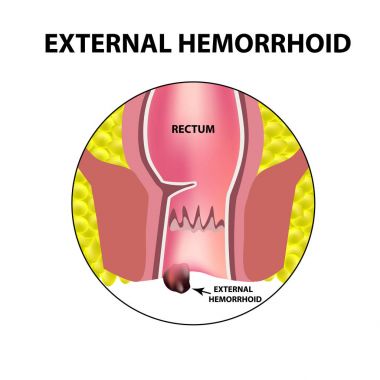 Dış hemoroid. Rektum yapısı. Bağırsak. iki nokta üst üste. İç hemoroidal düğüm. Infographics. Vektör illüstrasyon izole arka plan üzerinde.