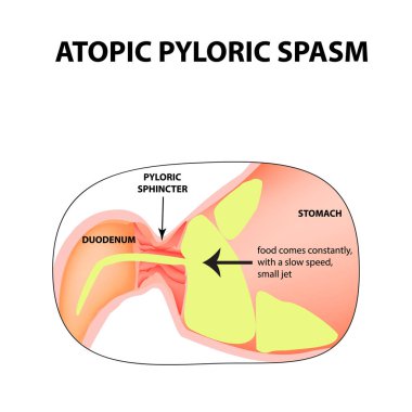 spasms of the pylorus. Pylorospasm. atonic. Pyloric sphincter of the stomach. Infographics. Vector image on isolated background clipart