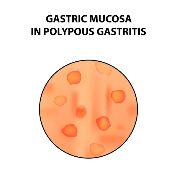 Gastric mucosa in polypous gastritis. Infographics. Vector illustration on isolated background — Stock Vector