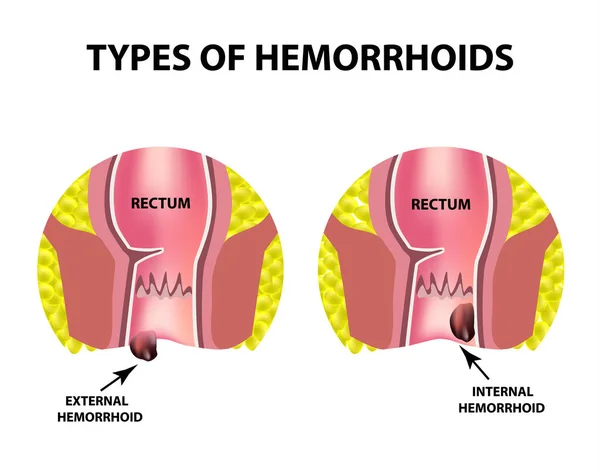 Dos tipos de hemorroides son externas e internas. Estructura del recto. Intestinos. colon. Nódulo hemorroidal interno y externo. Infografías. Ilustración vectorial sobre fondo aislado — Archivo Imágenes Vectoriales
