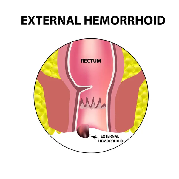 Emorroidi esterne. Struttura del retto. Intestini. Due punti. Nodo emorroidario interno. Infografica. Illustrazione vettoriale su sfondo isolato . — Vettoriale Stock