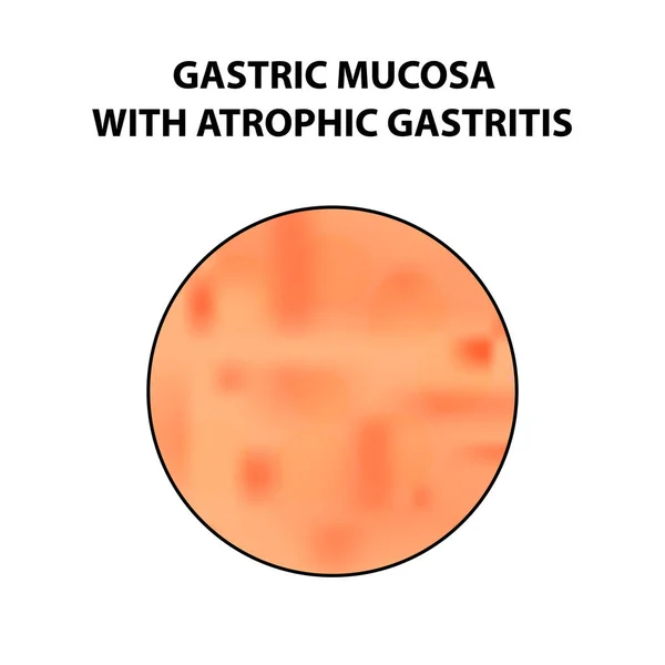 Atrophiás gastritis Gyomor nyálkahártya. Infographics. Elszigetelt háttér vektor illusztráció — Stock Vector