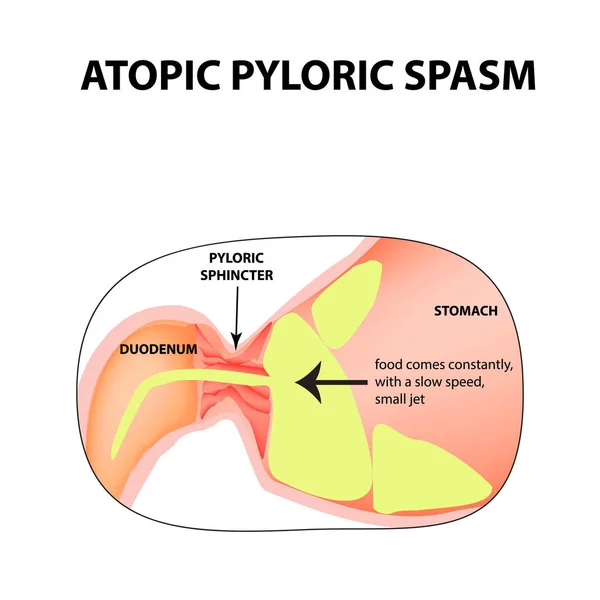 Spasms of the pylorus. Pylorospasm. atonic. Pyloric sphincter of the stomach. Infographics. Vector image on isolated background — Stock Illustration Spasms of the pylorus. Pylorospasm. atonic. Pyloric sphincter of the stomach. Infographics. Vector image on isolated background Royalty Free Stock Illustrations
