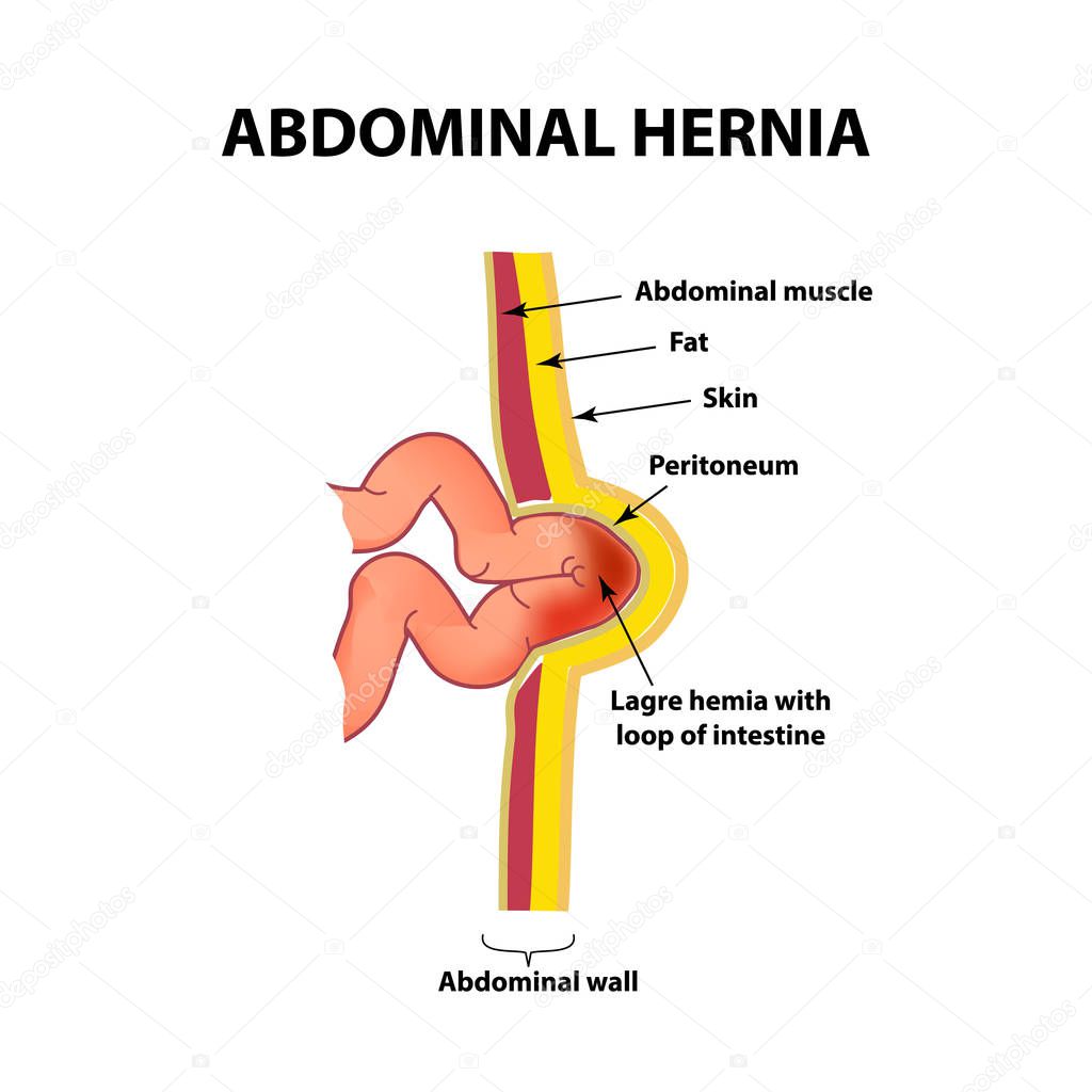 Hernia intestinal. Infografías. Ilustración vectorial sobre fondo