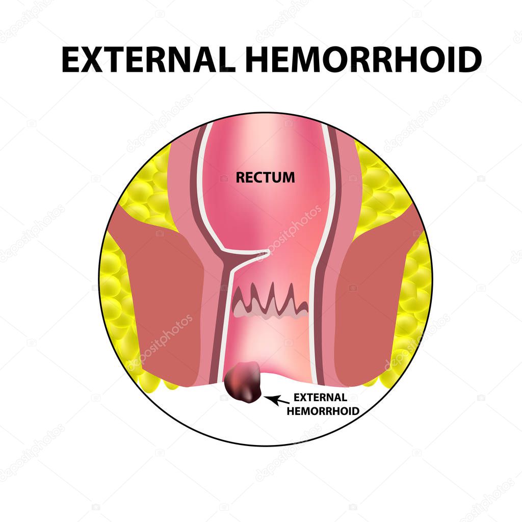 Hemorrhoids external. Rectum structure. Intestines. colon. Internal hemorrhoidal node. Infographics. Vector illustration on isolated background.