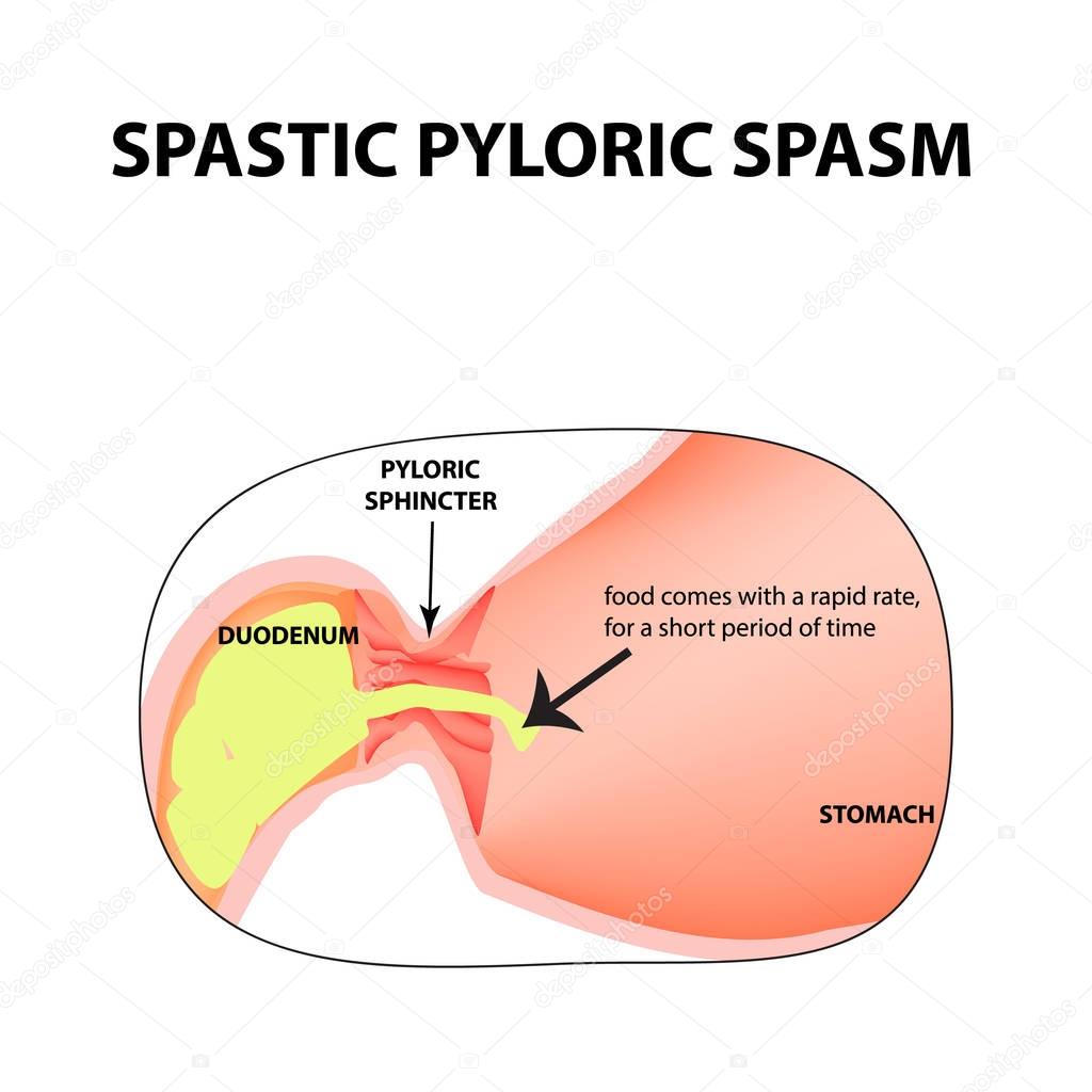 spasms of the pylorus. Pylorospasm. Spastic Pyloric sphincter of the stomach. Infographics. Vector image on isolated background