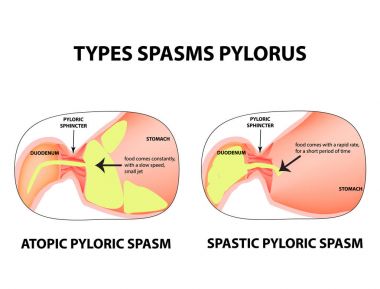 Types of spasms of the pylorus. Pylorospasm. Spastic and atonic. Pyloric sphincter of the stomach. Infographics. Vector image on isolated background clipart