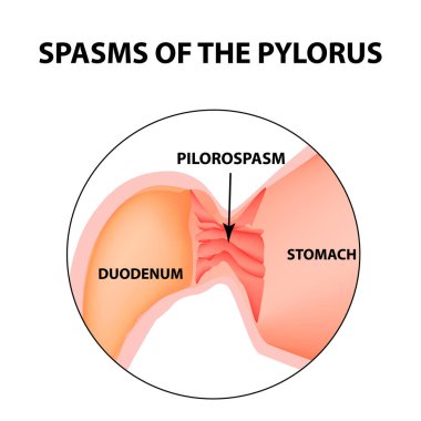 spasms of the pylorus. Pylorospasm. Spastic and atonic. Pyloric sphincter of the stomach. Infographics. Vector image on isolated background clipart