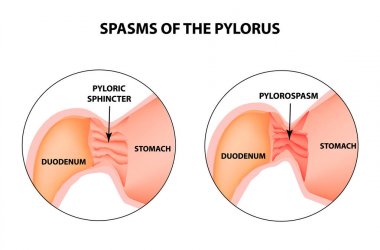 spasms of the pylorus. Pylorospasm. Spastic and atonic. Pyloric sphincter of the stomach. Infographics. Vector image on isolated background clipart