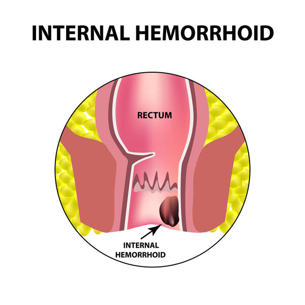Hemorrhoids internal. Rectum structure. Intestines. colon. Internal hemorrhoidal node. Infographics. Vector illustration on isolated background.