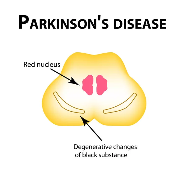 Parkinsons sjukdom. Degenerativa förändringar i hjärnan är en svart substans. Vektorillustration på isolerade bakgrund. — Stock vektor