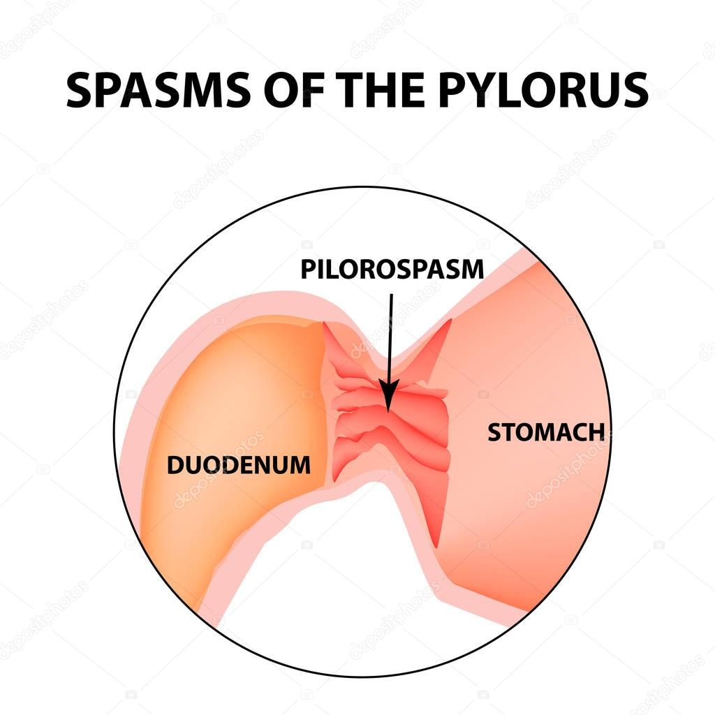 spasms of the pylorus. Pylorospasm. Spastic and atonic. Pyloric sphincter of the stomach. Infographics. Vector image on isolated background