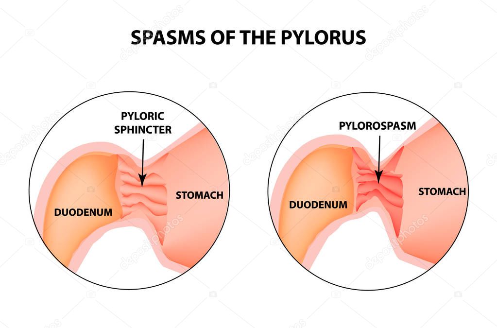 spasms of the pylorus. Pylorospasm. Spastic and atonic. Pyloric sphincter of the stomach. Infographics. Vector image on isolated background