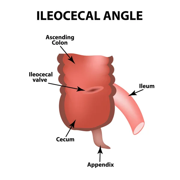 Ángulo Ileocecal. Válvula Ileocecal. El amortiguador de Bauginiev. El íleon, el ciego, el apéndice. Colón. Infografías. Ilustración vectorial sobre fondo aislado . — Vector de stock