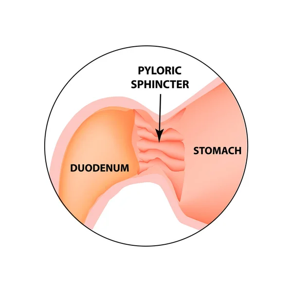 Gyomor záróizmán, a gyomor, duodenum. Pylorus. Infographics. Vektor kép elszigetelt háttér — Stock Vector