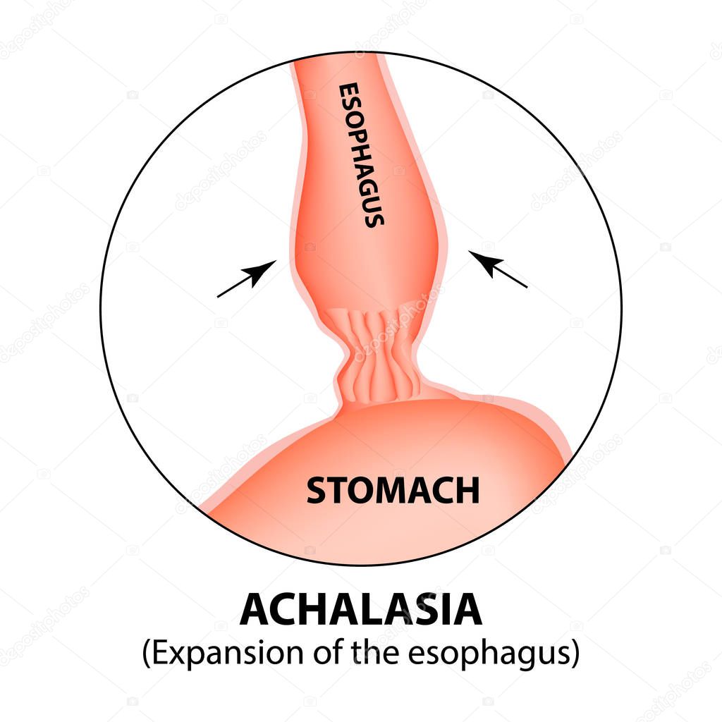 Achalasia of the esophagus. Expansion of the esophagus. Hernia. Infographics. Vector illustration on isolated background