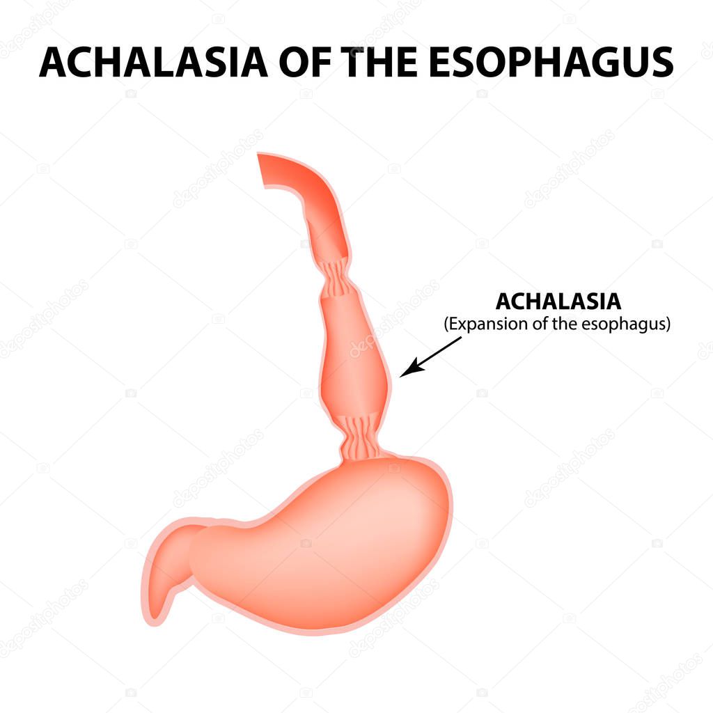 Achalasia of the esophagus. Expansion of the esophagus. Hernia. Infographics. Vector illustration on isolated background