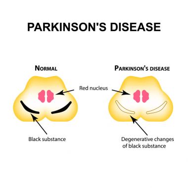 Parkinson's disease. Degenerative changes in the brain are a black substance. Vector illustration on isolated background. clipart