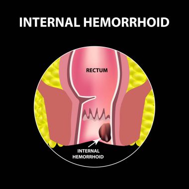 Hemoroid iç. Rektum yapısı. Bağırsak. iki nokta üst üste. İç hemoroidal düğüm. Infographics. Vektör çizim siyah arka plan üzerine