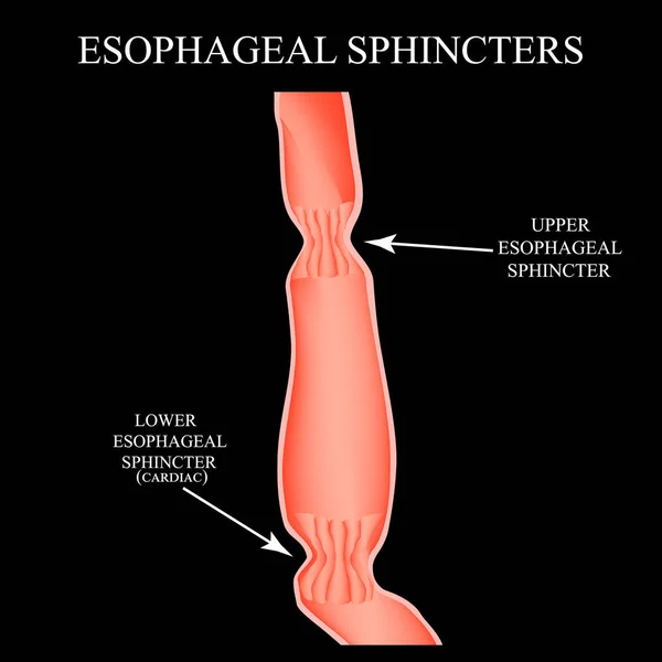 Sphincter supérieur d'œsophage. Sphincter oesophagien inférieur. Infographie. Illustration vectorielle sur fond noir . — Image vectorielle