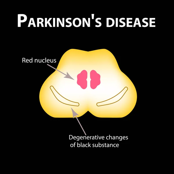 Parkinsonova nemoc. Degenerativní změny v mozku jsou černé látky. Vektorové ilustrace na černém pozadí. — Stockový vektor