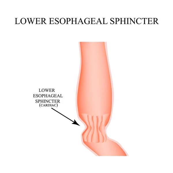 Esfíncter esofágico cardíaco inferior. Infográficos. Ilustração vetorial sobre fundo isolado . — Vetor de Stock