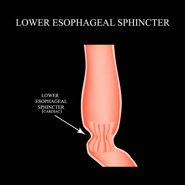 Lägre hjärt matstrupen sphincter. Infographics. Vektorillustration på svart bakgrund. — Stock vektor