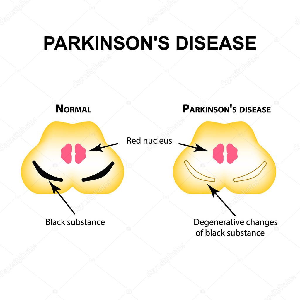 Parkinson's disease. Degenerative changes in the brain are a black substance. Vector illustration on isolated background.