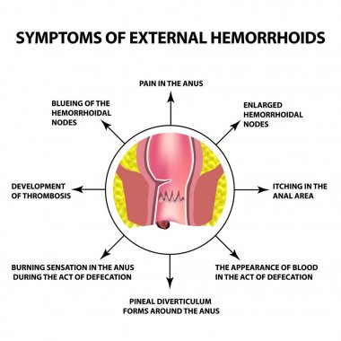 Dış hemoroid belirtileri. Rektum hemoroidal düğümünde anüs. Infographics. Vektör illüstrasyon izole arka plan üzerinde.