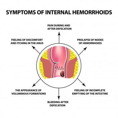 İç hemoroid belirtileri. Rektum hemoroidal düğümünde anüs. Infographics. Vektör illüstrasyon izole arka plan üzerinde.