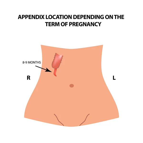 La ubicación del apéndice depende del término del embarazo. 8-9 meses. Infografías. Ilustración vectorial sobre fondo aislado . — Vector de stock