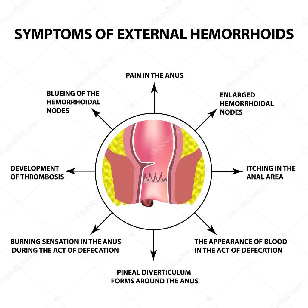 Symptoms of external hemorrhoids. The hemorrhoidal node in the rectum, anus. Infographics. Vector illustration on isolated background.