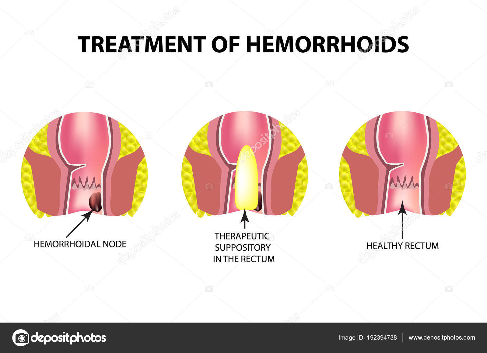 Treatment Of Hemorrhoids With Suppositories Infographics Vector