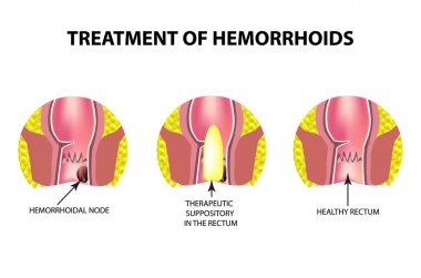 Fitil ile hemoroid tedavisi. Infographics. Vektör illüstrasyon izole arka plan üzerinde.