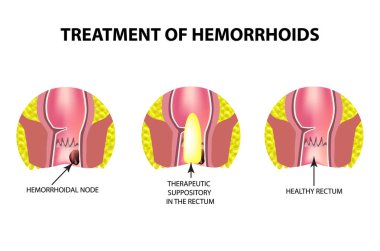 Treatment of hemorrhoids with suppositories. Infographics. Vector illustration on isolated background. clipart