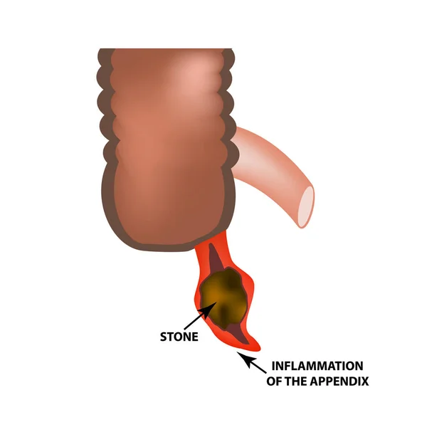 Inflamación del apéndice. Apendicitis. Piedra preciosa. Infografías. Ilustración vectorial sobre fondo aislado . — Vector de stock