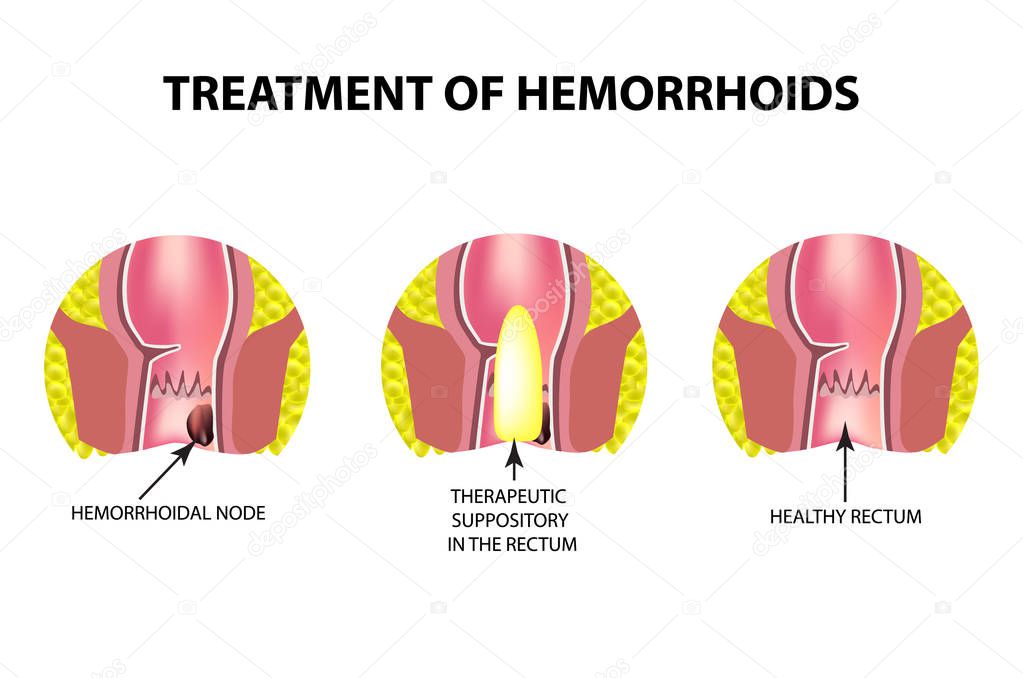 Treatment of hemorrhoids with suppositories. Infographics. Vector illustration on isolated background.