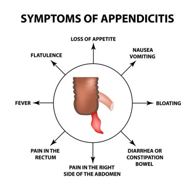 Symptoms of appendicitis. Inflammation of the appendix. Infographics. Vector illustration on isolated background.